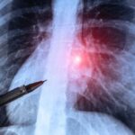 A chest X-ray with a pen pointing at a highlighted area