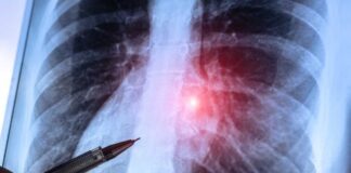 A chest X-ray with a pen pointing at a highlighted area