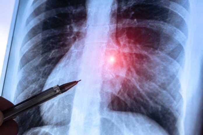 shutterstock_2695197415.jpg A chest X-ray with a pen pointing at a highlighted area